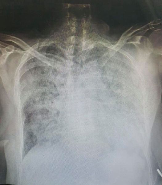 Рентген пациента без вакцины.
