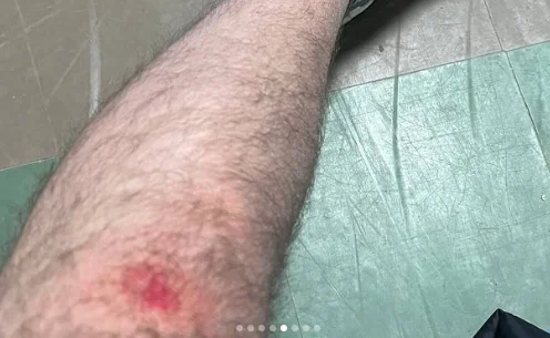 Муж получил ушибы во время силовой мобилизации. Фото: Instagram Виолетта Таран